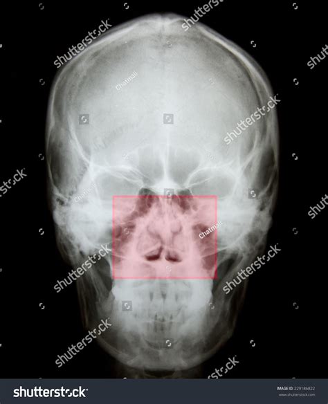 X Ray Nasal Bone Fracture After Foto stock 229186822 | Shutterstock