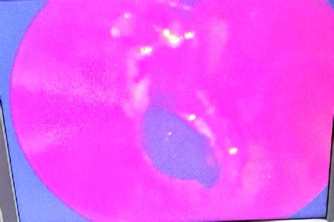 Endoscopic appearance of the left choana after choanal atresia release ...