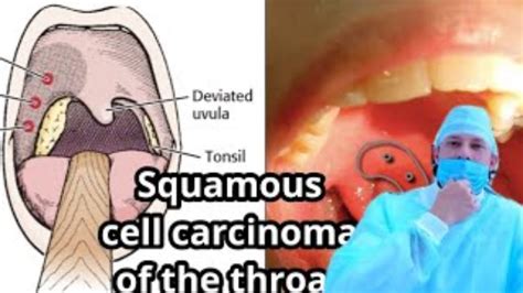 Squamous cell carcinoma of the throat , squamous cell carcinoma of the ...