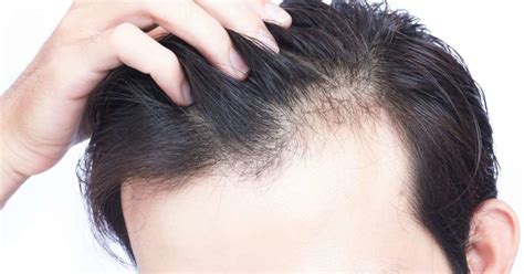 Vitamin D deficiency hair loss: Symptoms and treatment