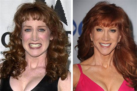 Kathy Griffin Plastic Surgery BEFORE and AFTER Pics