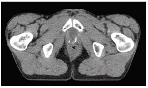 Life | Free Full-Text | Prostate Cancer Aggressiveness Prediction Using CT Images