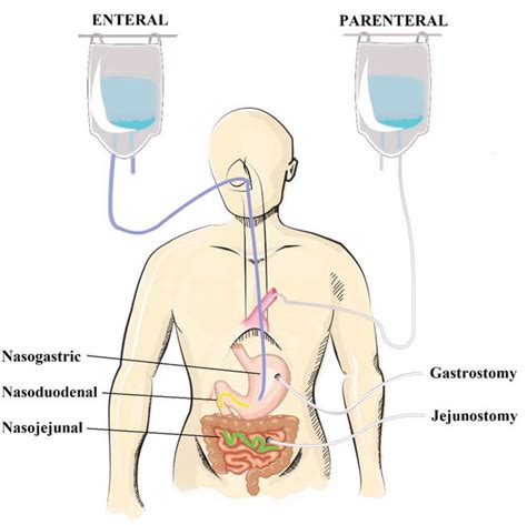 Enteral Feeding Vs Total Parenteral Nutrition - Nutrition Pics