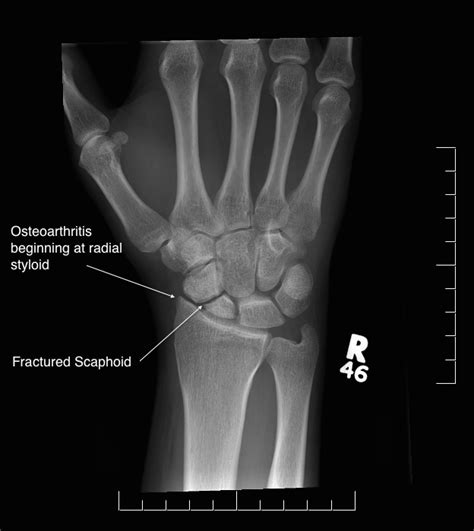 Hands – Arthritis - Auckland OrthopaedicsAuckland Orthopaedics