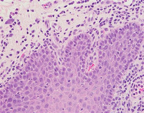 Cureus | Oral Psoriasis of the Tongue: A Case Report