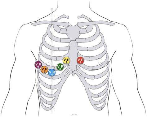 ECG Lead positioning • LITFL • ECG Library Basics