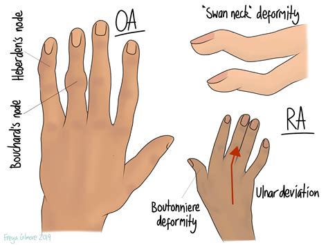 Rheumatoid Arthritis — | Naas Osteopaths | Kildare Osteopath | Children ...