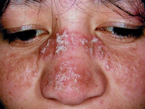 Discoid Lupus Erythematosus Primarily Affects Your Skin