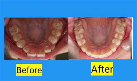 Palate Expander Before And After: 2023 – Amasvos