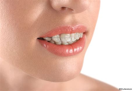 A Porcelain Glaze Can Reduce the Appearance of Braces Hardware | Corsa Orthodontics