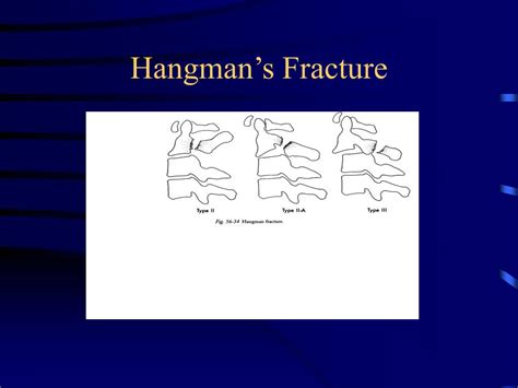 PPT - Cervical Spine Injuries Classification and Non-operative ...