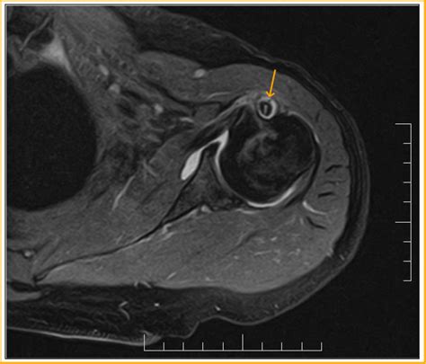 Long Head Biceps Tear-MRI - Sumer's Radiology Blog