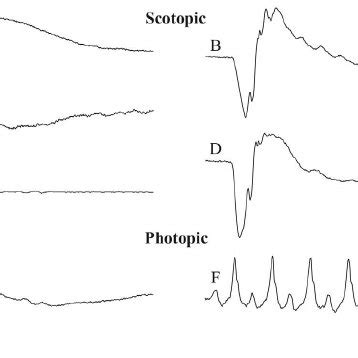 Summarized schematic procedure describing a typical electroretinography... | Download Scientific ...