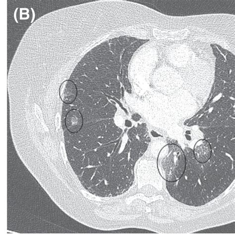 (PDF) COVID‐19 pneumonia in a patient with sarcoidosis: A case report