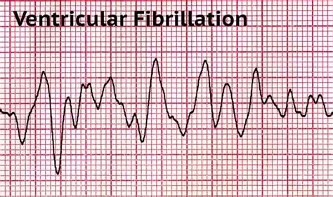 Diagnosis Fibrilasi Ventrikel - Alomedika