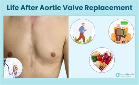 What to Expect 6 Months After Aortic Valve Replacement?