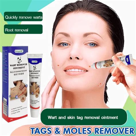 【2 pcs】 Wart removal cream face wart removal cream | Lazada PH