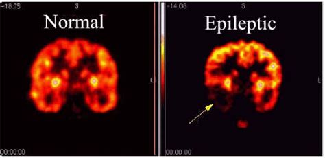 Epilepsy Diagnosis and Epilepsy Test - Health Normal