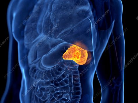 Spleen cancer, illustration - Stock Image - F034/9930 - Science Photo Library