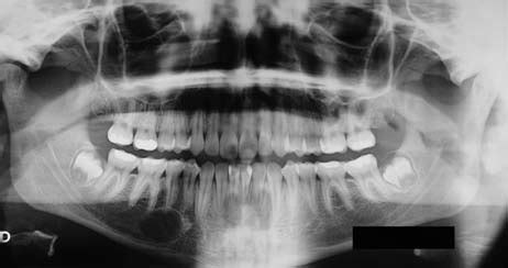 Periapical Cyst Radiograph