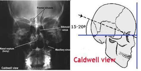 X-Ray: Caldwell View | X ray, Nasal septum, Maxillary sinus