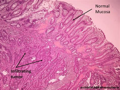 Pathology of Adenocarcinoma-Colon - Pathology Made Simple