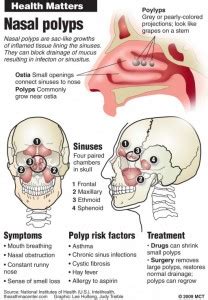 Nasal Polyps - Causes, Symptoms, Pictures, Treatment and Surgery