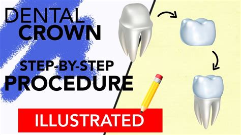 Dental Crown Step-By-Step Procedure Illustrated - YouTube