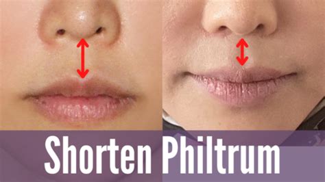 Shorten philtrum | Koko Face Yoga