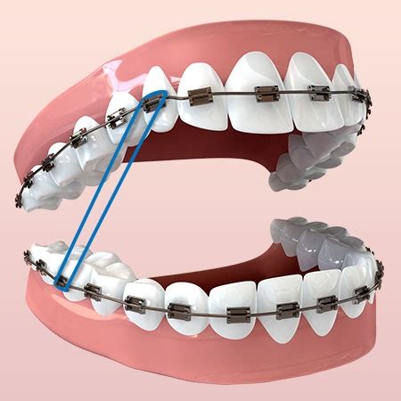 All About Elastic Rubberbands — Land Orthodontics