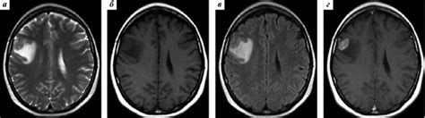 T2-weighted (a), T1-weighted (б), T2-FLAIR (в), and contrast-enhanced... | Download Scientific ...