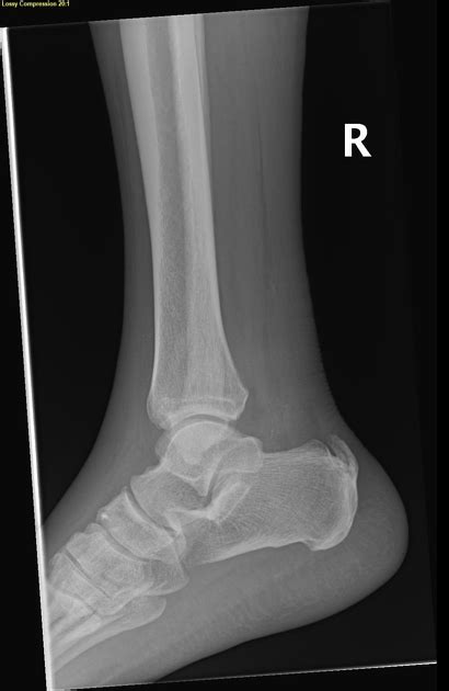 Plantar Calcaneal Enthesophyte