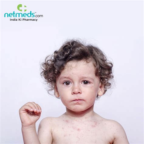 Atopic Dermatitis affects kids at an early age