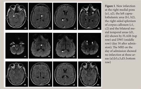 Figure 1 from Bacterial meningitis and neurological complications in adults | Semantic Scholar