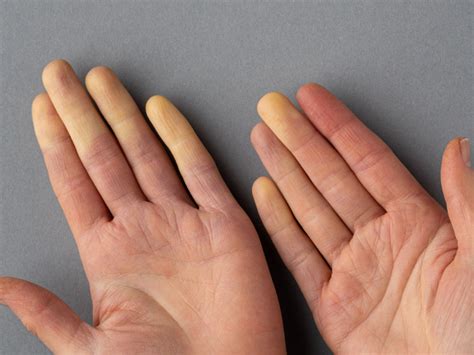 What is Raynaud’s and What Can You Do About It?