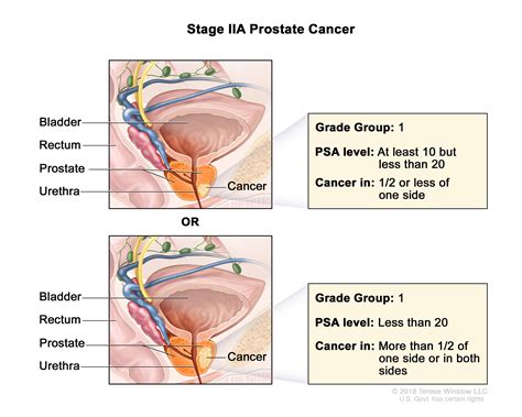 Prostate Cancer Treatment (PDQ®) - NCI