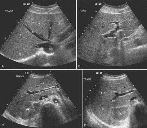 Ultrasound of the liver, biliary tract, and pancreas | Ultrasound, Medical ultrasound ...