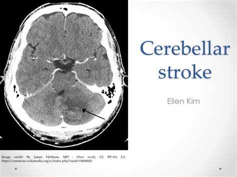 Cerebellar Stroke — learnED