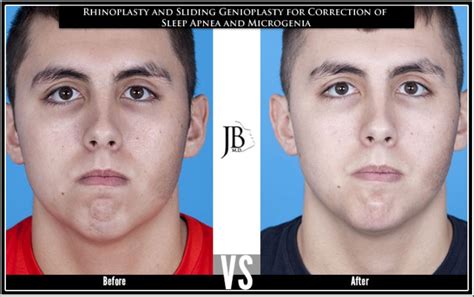 Chin Augmentation for Men | San Antonio | Dr. Jose Barrera