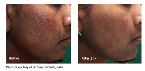 Mothlhtqqjbpqdp: Co2 Laser For Acne Scars Before And After