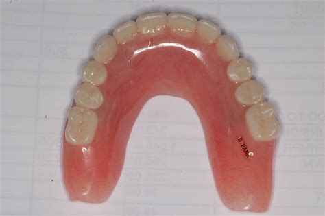 Periodontal - Implant Cases by Dr. Thomas Kang: A maxillary overdenture case