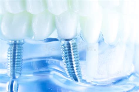 Dental Titanium Tooth Implant Stock Photo - Image of model, medical: 108409202