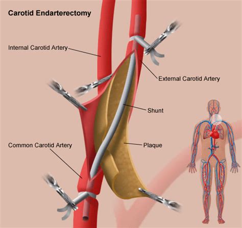 Carotid artery surgery risks elderly | Astral Projection