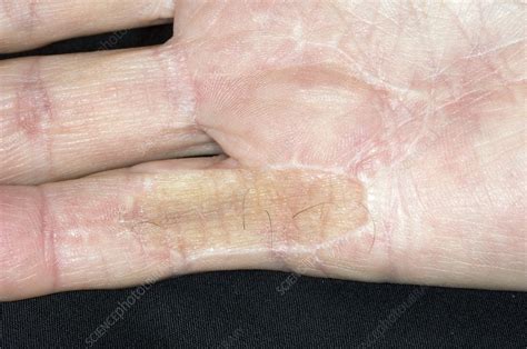 Scar from Dupuytrens contracture surgery - Stock Image - C008/5776 - Science Photo Library