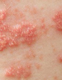 Pustular Psoriasis: Spotting Symptoms and Treating the Condition