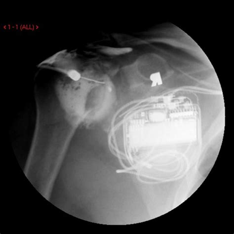 Mri Arthrogram Shoulder Rotator Cuff Tear