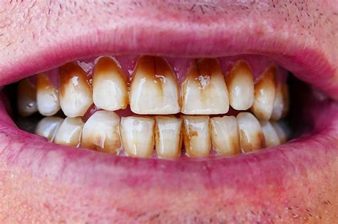 Effects of Marijuana Use on Oral Health | Absolute Dental