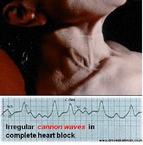 junctional tachycardia and regular cannon waves | Dr.S.Venkatesan MD