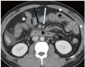 Mesenteric vein thrombosis - WikEM