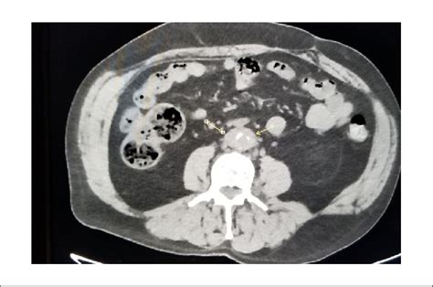 Retroperitoneal fibrosis. | Download Scientific Diagram